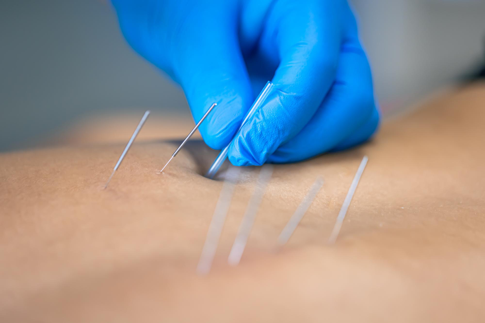 Acupuncture Therapy